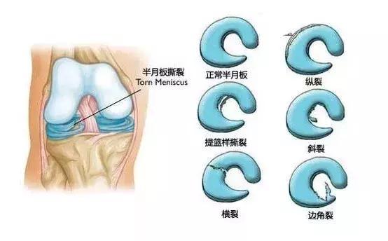 骨小雅講堂 | 半月板毀傷 最輕易產生在這兩類人身上 健康 第1張