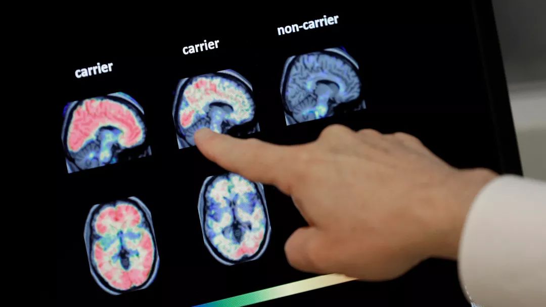 科學家們密切關註阿爾茨海默病的血液檢查 健康 第1張