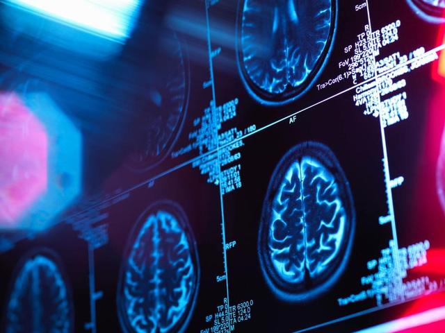 壓力究竟對我們做了什麼？研究發現「壓力山大」會導致大腦縮小 健康 第1張