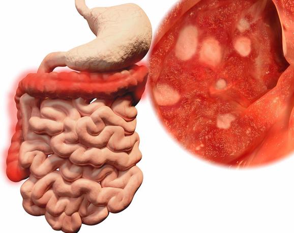 腸道健康才能長壽！5個症狀說明腸道老了，四個方法改善腸道健康 健康 第1張