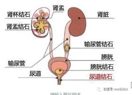 悲劇！這顆腎，就這樣硬給