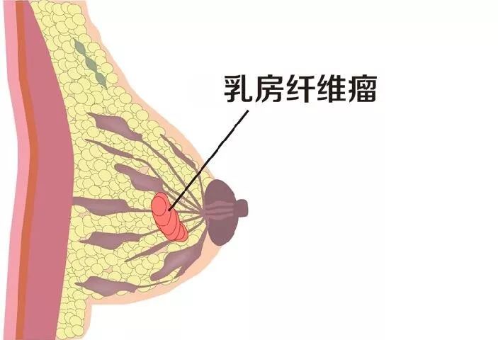 做女人好難，女性好發的乳腺纖維瘤要手術嗎？ 健康 第5張