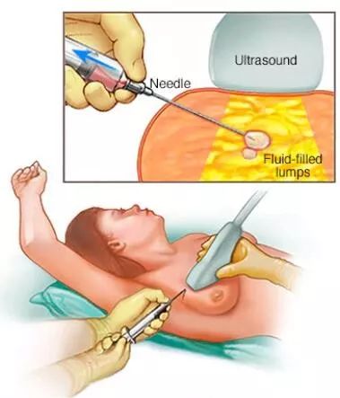 做女人好難，女性好發的乳腺纖維瘤要手術嗎？ 健康 第6張