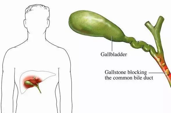 說說膽囊那些事兒 健康 第1張