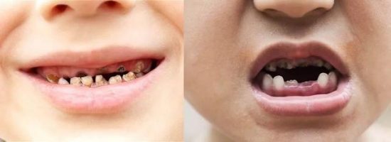 加拿大牙醫Price花了10年研究發現：正確飲食與牙齒保護、人體健康有正相關…… 健康 第1張