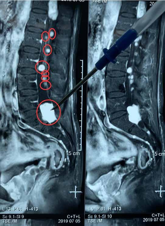 男子脊柱內現「葡萄串」腫瘤！歷時7小時全部切除 健康 第1張