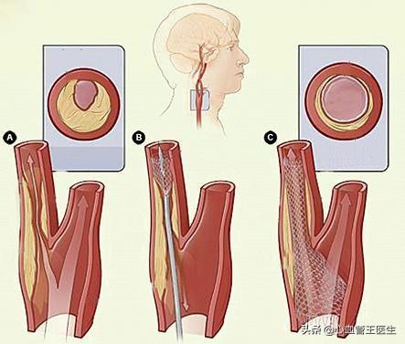 改善心血管疾病/為什麼頸動脈更容易發生斑塊和狹窄，導致腦梗死？醫生這次講明白 汪醫師產文 第6張