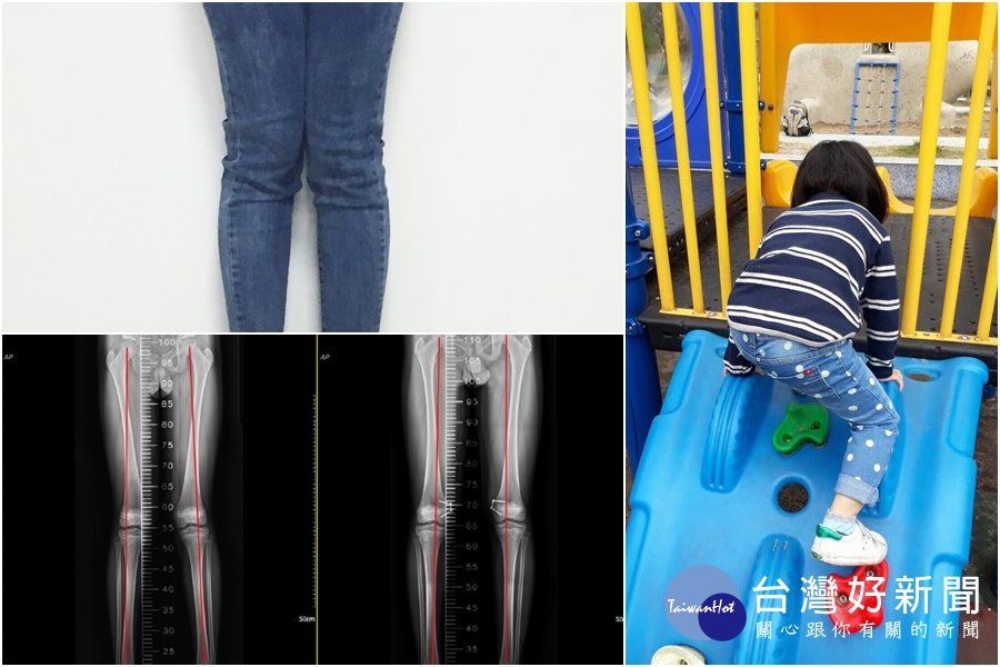 把握治療黃金期　變型腿微創手術恢復正常雙腿 台灣好新聞 第1張