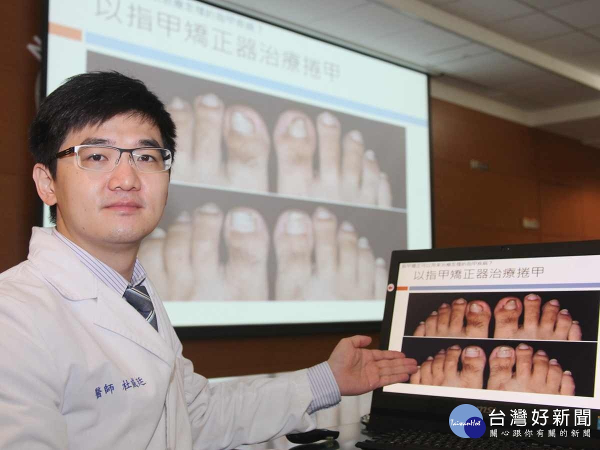 治療捲甲及嵌甲的新方法　醫師：「指甲矯正」減輕疼痛及發炎 台灣好新聞 第1張