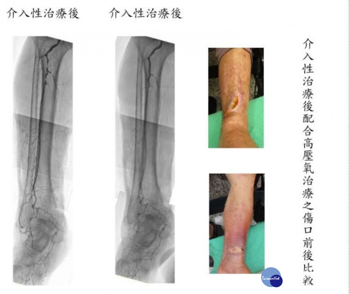 嚴重周邊動脈阻塞性疾病　恐將面臨截肢命運 台灣好新聞 第1張