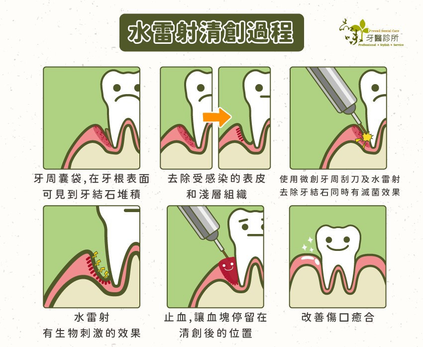 牙周病治療新福音　水雷射可深層滅菌又不怕牙齦大幅萎縮 台灣好新聞 第1張