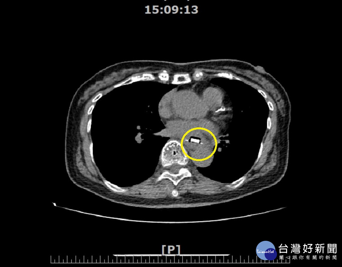 幼兒長輩服藥小心　阿嬤吃藥誤吞鋁箔包裝就醫 台灣好新聞 第1張