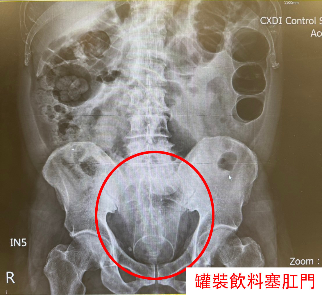 肛門塞罐裝飲料　醫微創手術取出 台灣好新聞 第1張