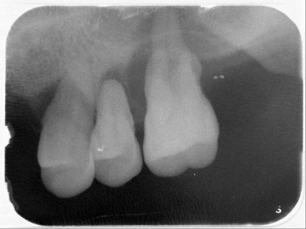 北榮桃園分院提醒牙周病隱形危機　別錯過治療時機