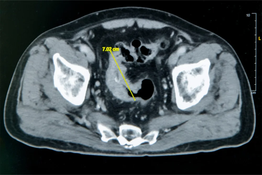 老翁罹患乙狀結腸癌,腫瘤約7公分造成腸子幾乎完全阻塞。圖/彰基醫院提供