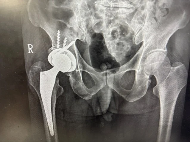 DAA微創髖關節手術　助病人快速恢復行動力