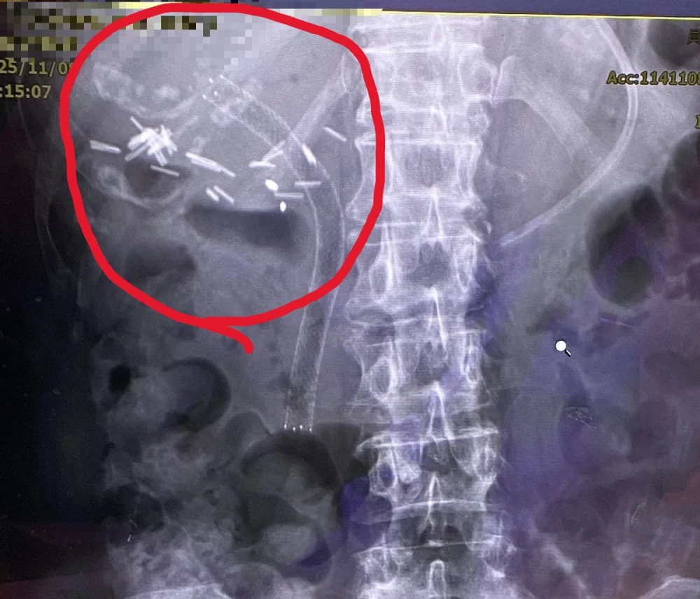 罹癌婦人發燒、噁心送急診  檢查：膽管道塑膠支架阻塞引起