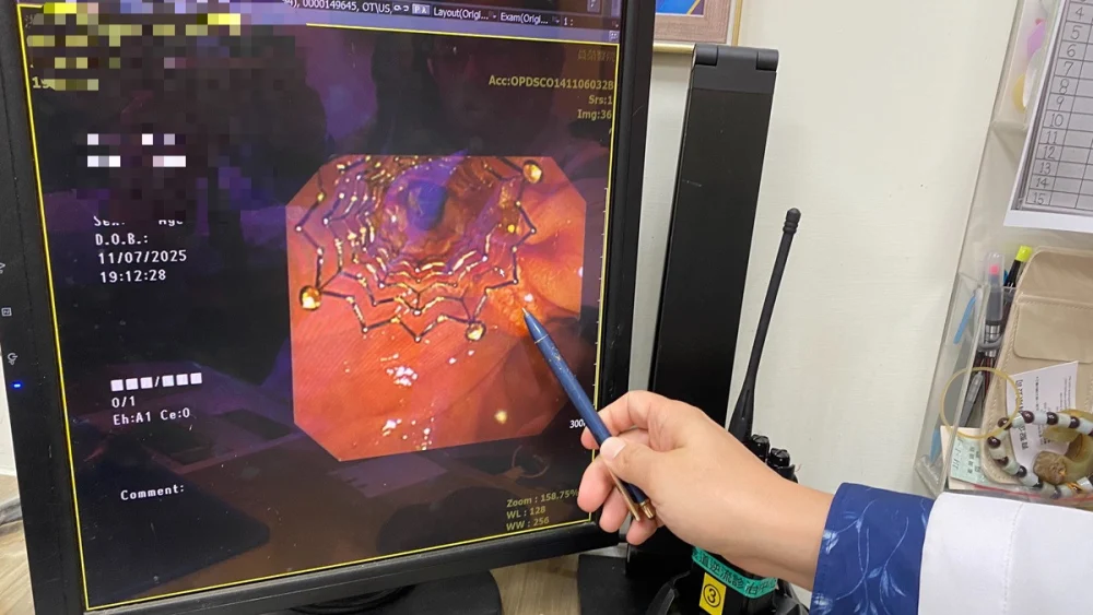 罹癌婦人發燒、噁心送急診　檢查：膽管道塑膠支架阻塞引起