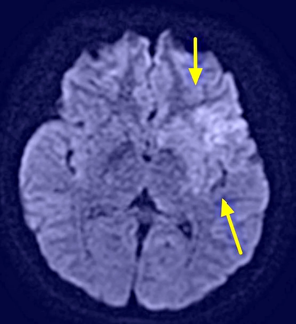 核磁共振影像，箭頭處呈現早期缺血變化