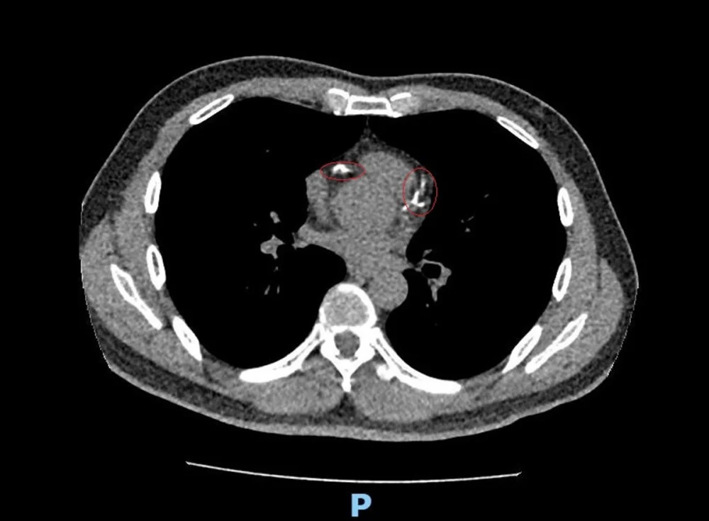 心血管硬斑也能震碎 49歲男發願捐108萬署彰受惠於醫療新技術
