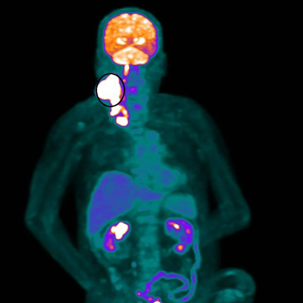 健保也能創造奇蹟   80歲癌末患者放射治療逆轉困境 
