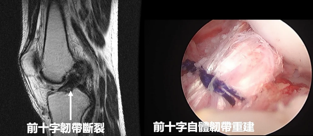 前十字韌帶斷裂前與手術重建