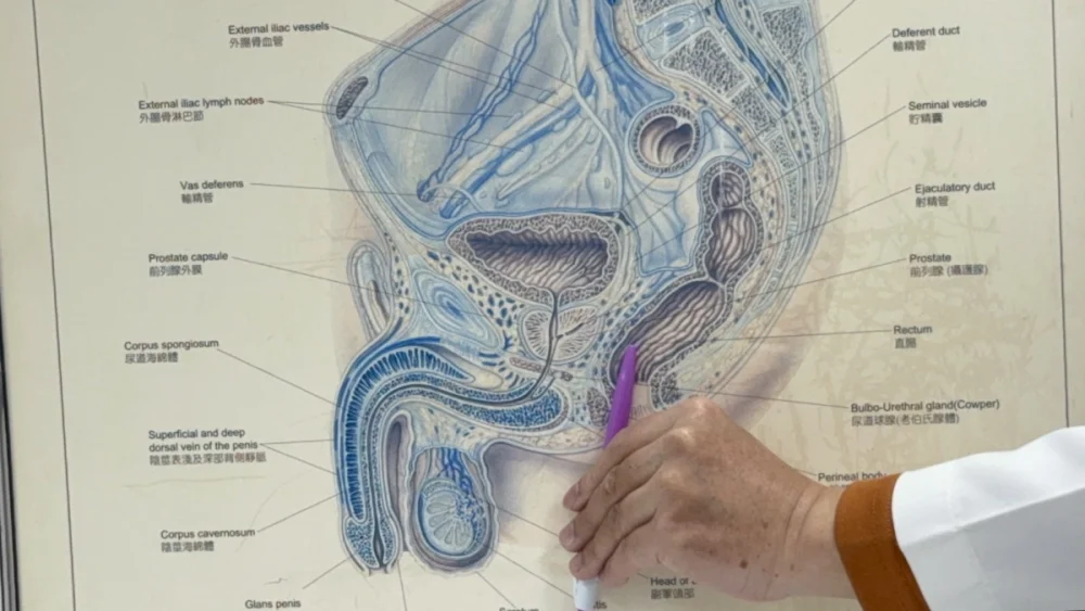 最新的海神刀超音波消融手術是將超音波探頭從直腸進入到攝護腺癌部位，透過磁振造影影像定位，精準進行熱聚焦消融手術，將腫瘤燙熟後使其自動剝落自尿管排出。圖/台中醫院