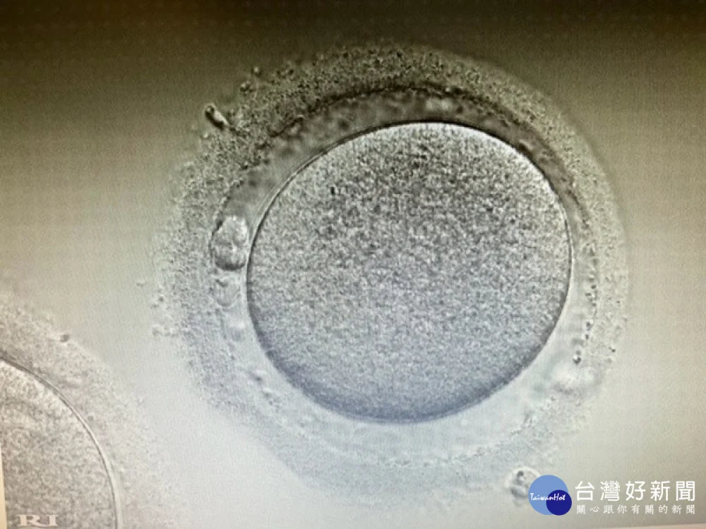 30歲化療女憂無法生育　仁愛長庚跨科攜手保「生機」