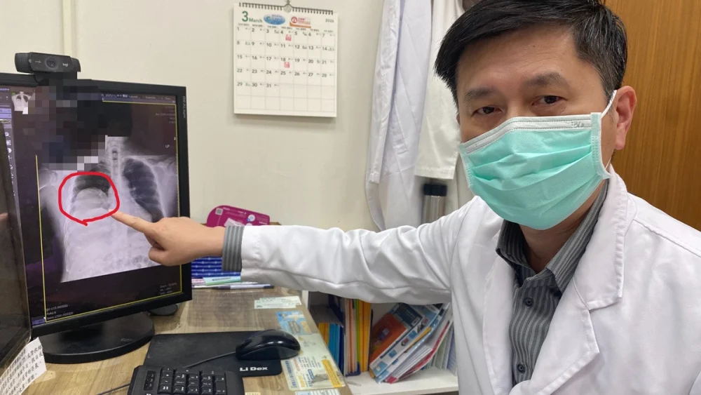 男子多次昏迷送醫，揪出25公分罕見肺腫瘤