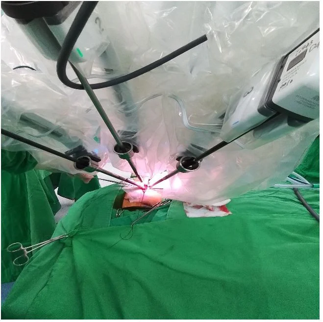 右側耳後切口的達文西腮腺手術。