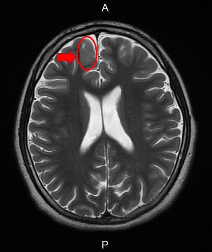 少年癲癇服藥仍頻繁發作　醫：可能與腦皮質發育不良有關