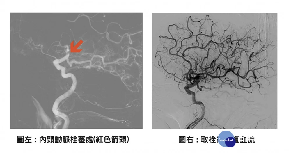 左圖紅色箭頭處為內頸動脈栓塞處，右圖為取栓後恢復血流