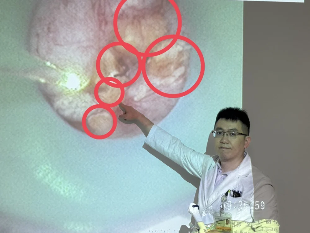 追劇不喝水50歲貴婦雙腎結石滿出來！　醫驚：像長滿葡萄乾的雜糧麵包