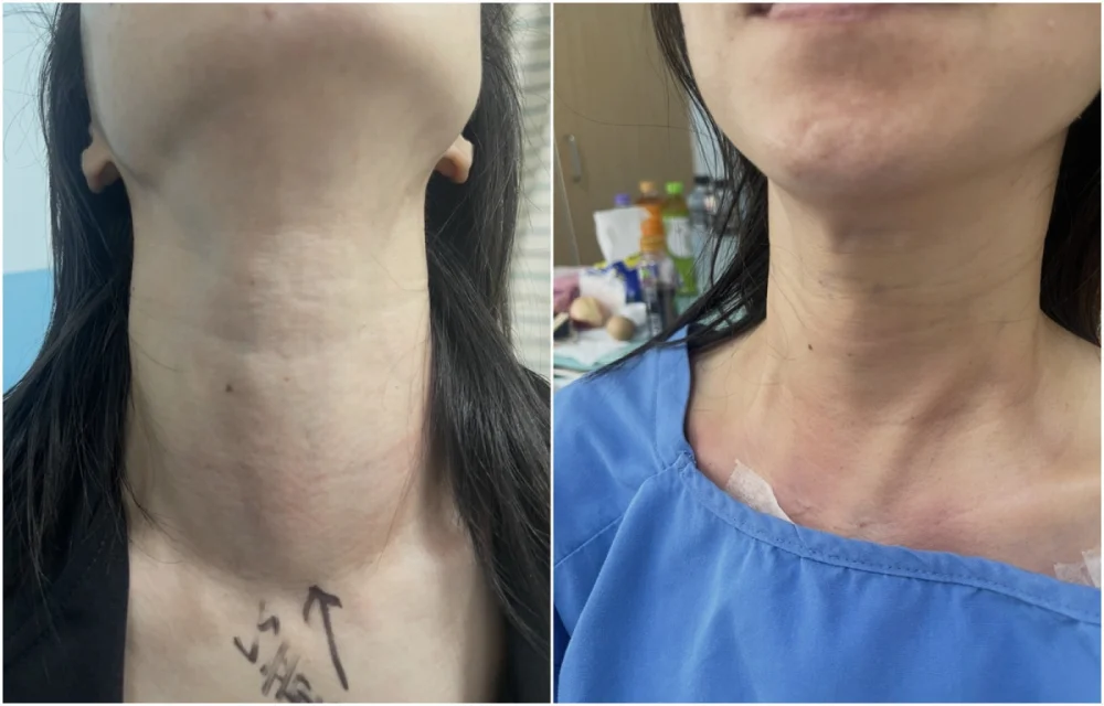 部桃達文西再突破　甲狀腺手術破百例